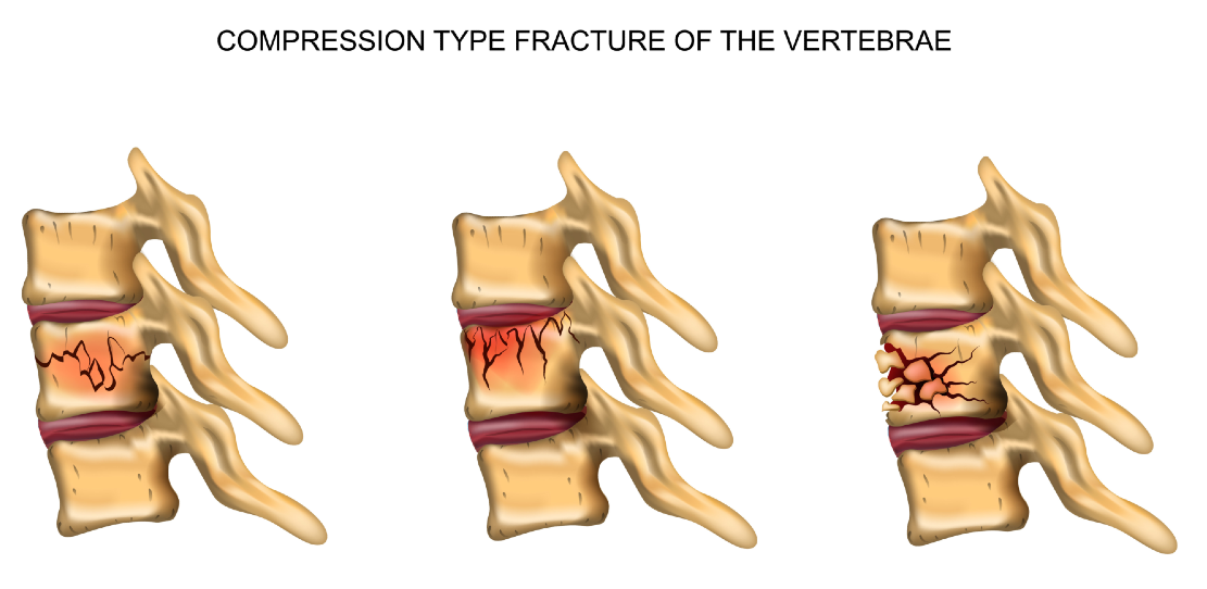 Compression Fracture